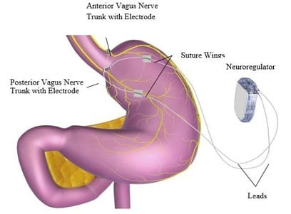 Graphic of a stomach post-surgery. Anterior Vagus Nerve Trunk with Electrode, Posterior Vagus Nerve Trunk with Electrode, Suture Wings, Leads, and Neuroregulator are labeled.
