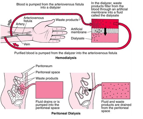 In hemodialysis, blood is pumped from the arteriovenous fistula into a dialyzer. In the dialyzer, waste products filter from the blood through an artificial membrane into a fluid called the dialysate. Purified blood is then pumped from the dialyzer into the arteriovenous fistula. In peritoneal dialysis, fluid drains or is pumped into the peritoneal space. Fluid and waste products are then drained from the peritoneal space.