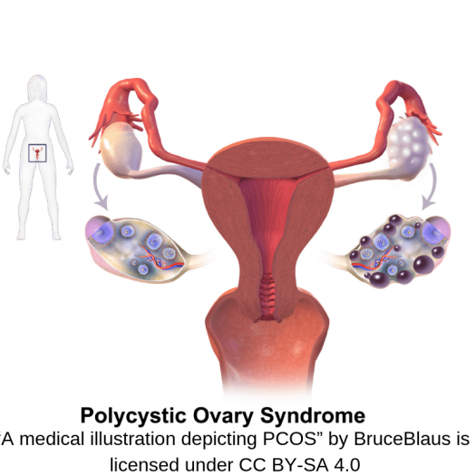 “Polycystic Ovary Syndrome - A medical illustration depicting PCOS” by BruceBlaus is licensed under CC BY-SA 4.0